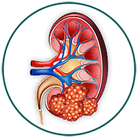 Acute Kidney Injury (AKI)