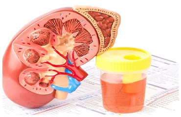 Hematuria (Blood in Urine)