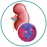 Interstitial Nephritis