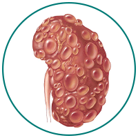 Kidney cysts