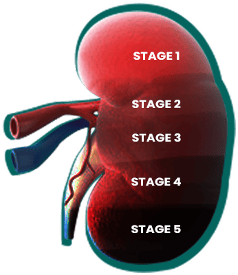 Stages of Chronic Kidney Disease