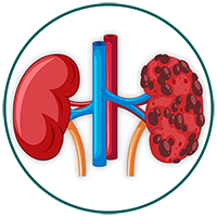 Polycystic Kidney Disease (PKD)