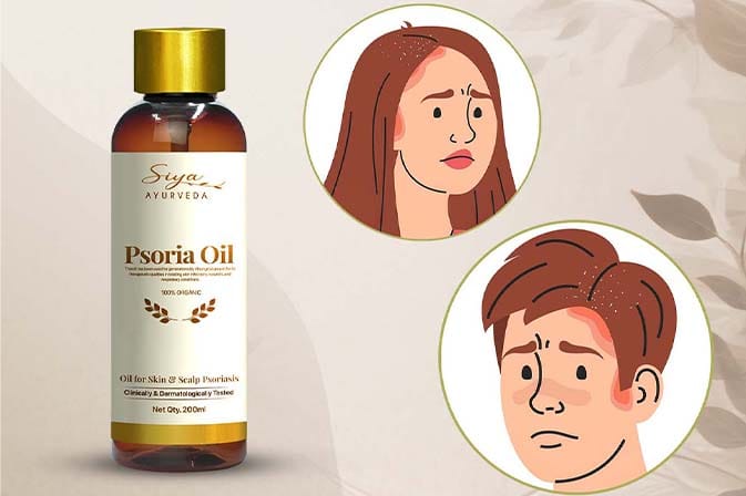 Psoria Oil Natural Solution for Scalp & Body Psoriasis Treatment