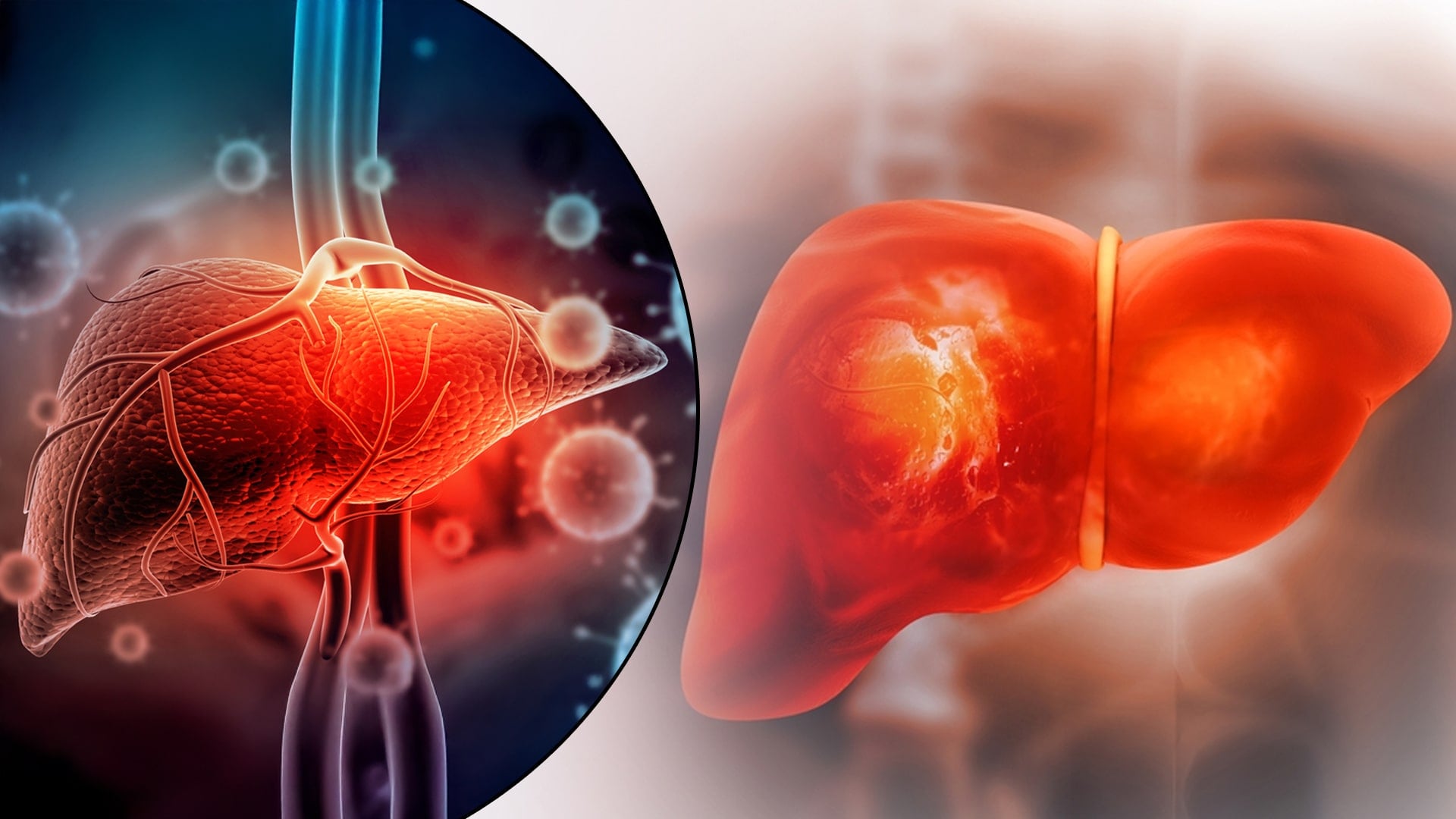 Can Fatty Liver Cause Cirrhosis of the Liver?