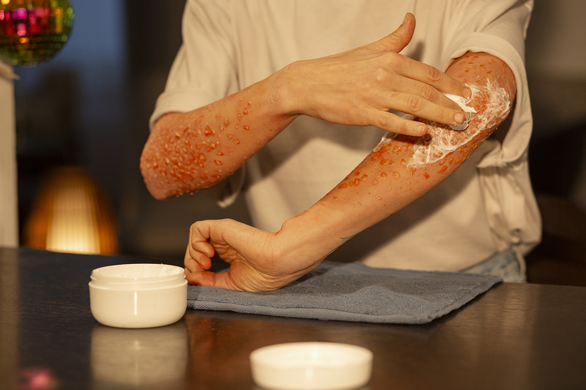 How to Cure Psoriasis Naturally with Ayurvedic Treatments