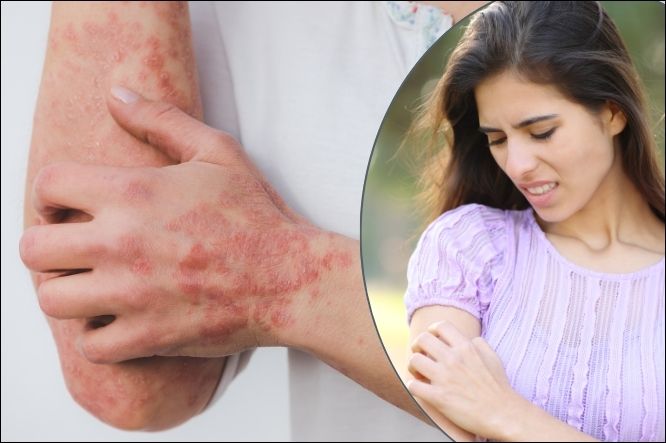 How to Cure Psoriasis Naturally with Ayurvedic Treatments